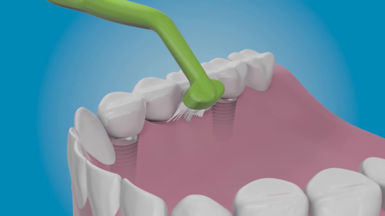 مراقبت بعد از کاشت ایمپلنت دندان