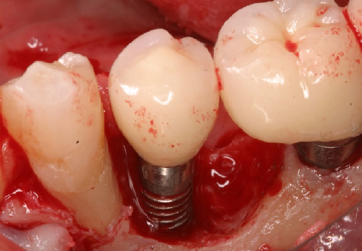 7 - شکست ایمپلنت دندان و عفونت ایمپلنت