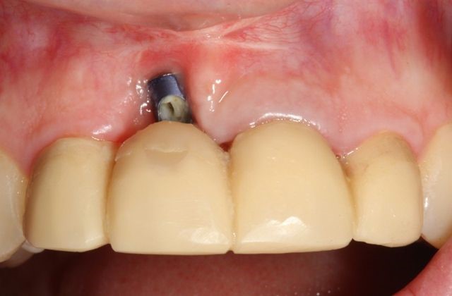 4 - آیا امکان کاشت ایمپلنت دندان با وجود بیماری لثه فراهم است؟