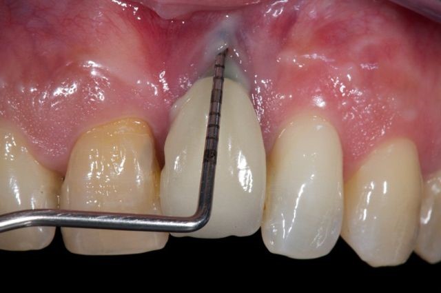 کاشت ایمپلنت دندان با وجود بیماری لثه