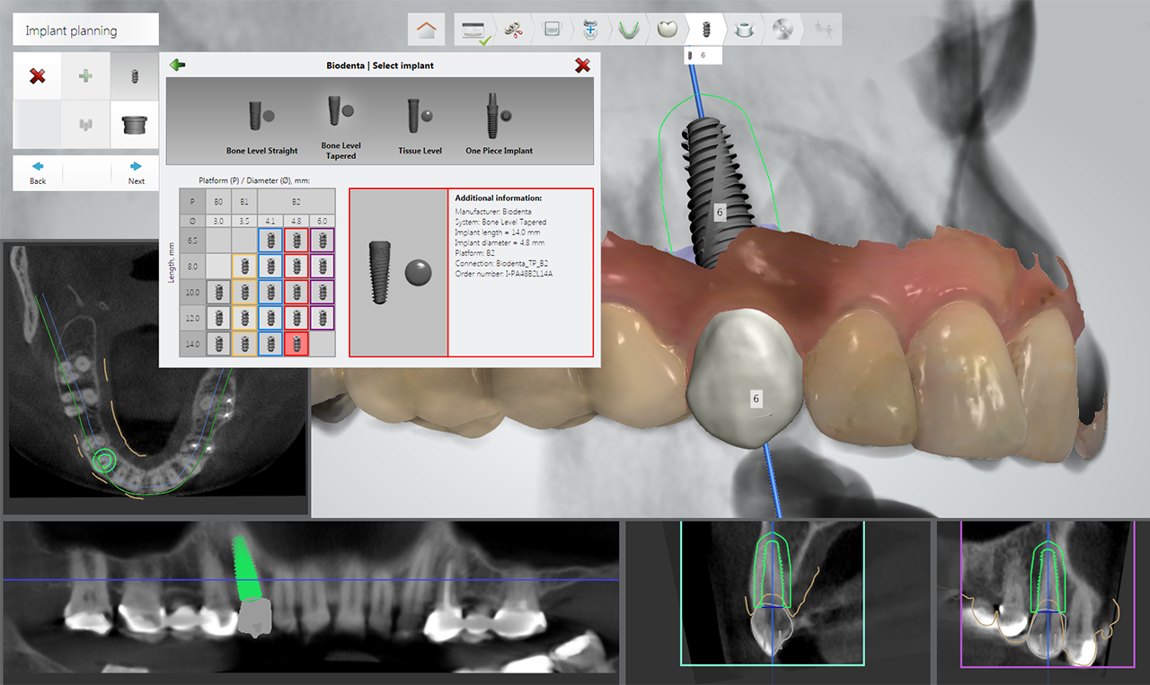 ایمپلنت دندان دیجیتالی