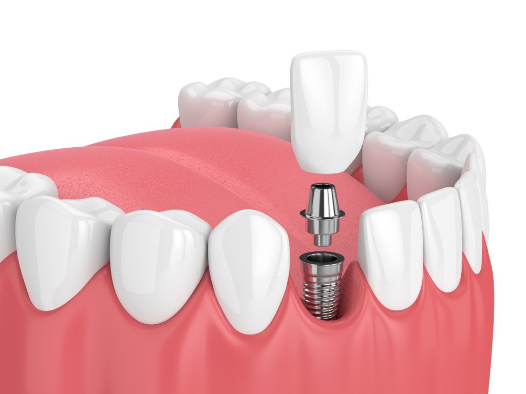 15 - انواع ایمپلنت های دندانی