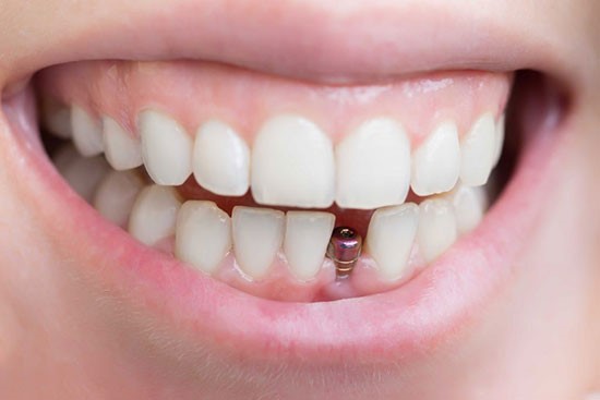 انواع ایمپلنت دندانی