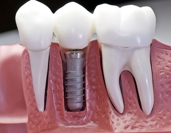 30 - آیا ایمپلنت دندان درد دارد؟