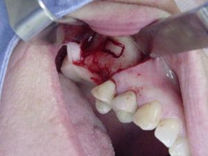 چه کسانی گزینه های مناسب جراحی سینوس لیفت هستند؟