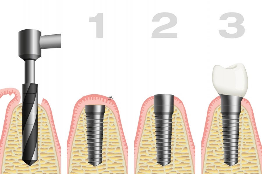 7 - لق شدن ایمپلنت دندان | دلایل و روش های پیشگیری