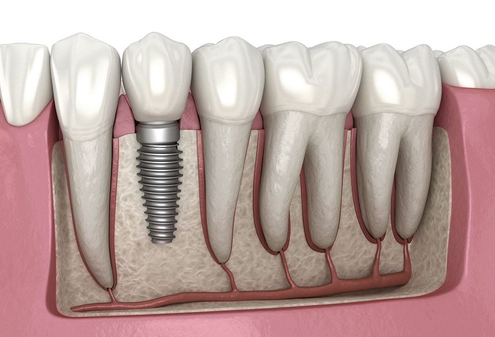 1 - عادت های نادرست در طول مدت کاشت ایمپلنت های دندانی