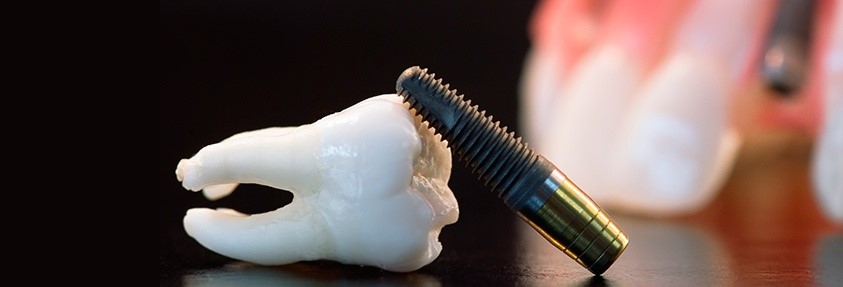 9 - پس زدن ایمپلنت دندان یکی از عوارض روش درمانی ایمپلنت است