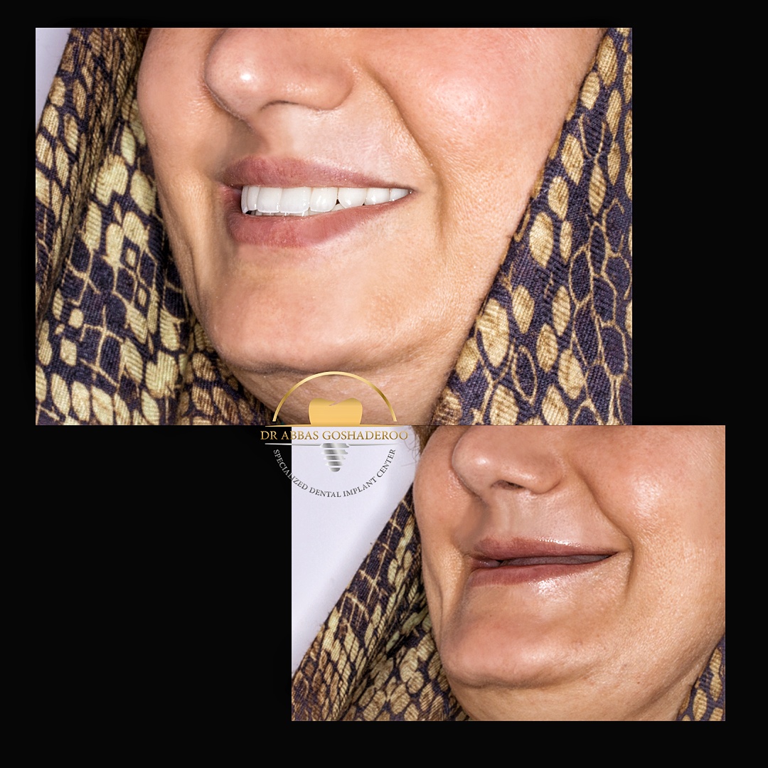 B A smile 01 - تاثیر بازسازی دندانها بر زاویه بینی و و لبها