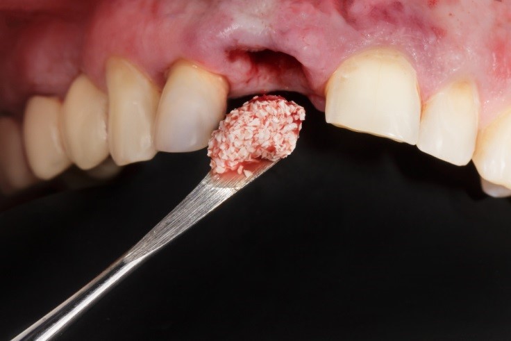 5 1 - انتظار شما از پیوند استخوان قبل از ایمپلنت دندان چیست؟