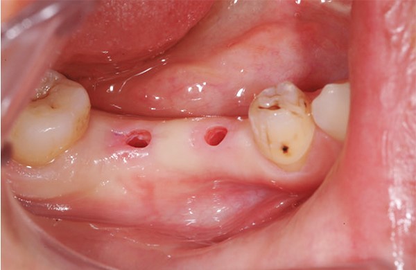 10 1 - ایمپلنت دندان به روش پانچ