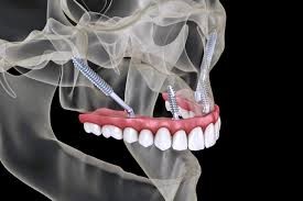 رژیم غذایی و سبک زندگی بعد از کاشت ایمپلنت های زیگوماتیک
