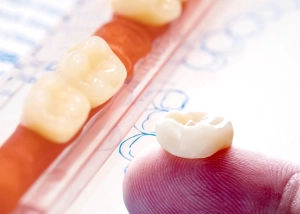 روکش های دندان از چه چیزی ساخته شده اند؟