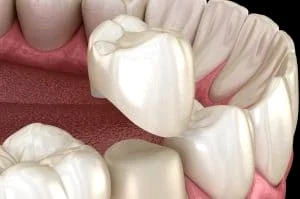 ساخت روکش موقت