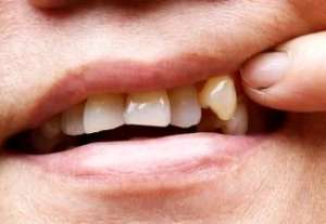 خطرات و عوارض درمان نکردن دندان لق چیست؟