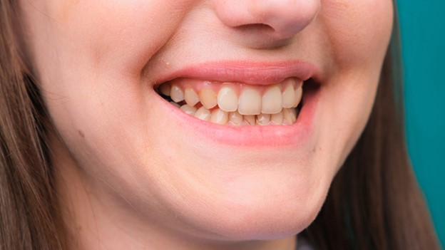 26 - علت زرد شدن دندان ها و راهکارهای درمان آنها