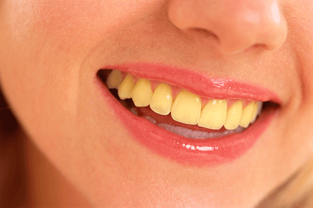 علت زرد شدن دندان