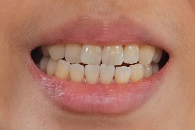 علت زرد شدن دندان