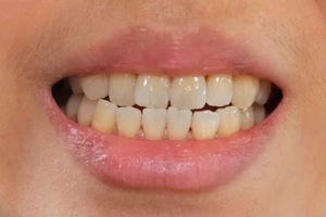 افسانه های دندان های زرد