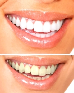 چگونه از شر زردی دندان ها خلاص شویم؟