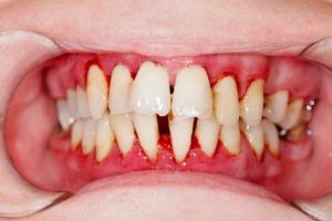 ایمپلنت دندان با وجود بیماری لثه