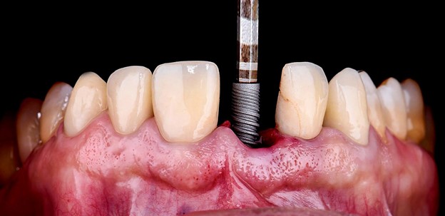 29 - چه چیزهایی مانع دریافت ایمپلنت های دندانی می شوند؟
