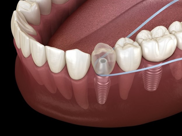 1 - نخ دندان کشیدن با ایمپلنت های دندانی