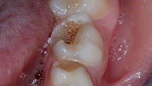 غدد بزاقی  برای سلامت دندان