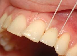 نخ دندان کشیدن ایمپلنت دندانی