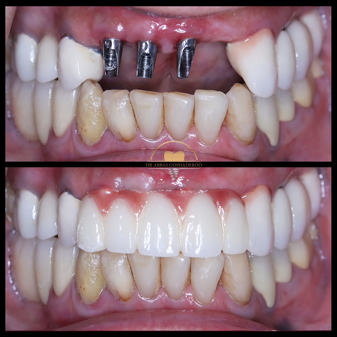 33 - بازسازی ناحیه قدامی دهان