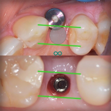 اشتباهات دندانپزشکان در کاشت ایمپلنت دندانی