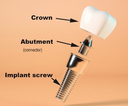  سست شدن روکش ایمپلنت دندان 