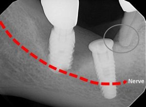 اشتباه شماره 5: درگیر شدن در مکان های کم عمق یا نزدیک شدن به عصب