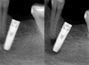 اشتباه شماره 6: عدم استفاده از فناوری CBCT برای طراحی درمان