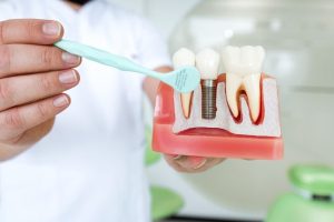 چرا بهداشت دهان بعد از جراحی ایمپلنت اینقدر مهم است؟
