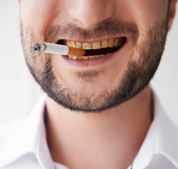 22 - تأثیر دخانیات روی از دست رفتن دندان ها
