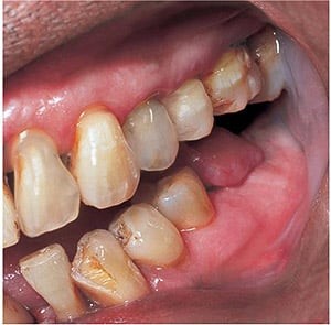تأثیر دخانیات روی از دست رفتن دندان