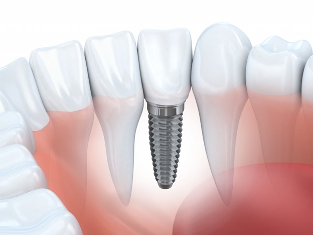تفاوت ایمپلنت و دندان طبیعی: پایه آنها استخوان فک است