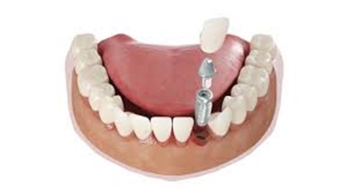 تفاوت ایمپلنت و دندن طبیعی: پوسیده نخواهند شد