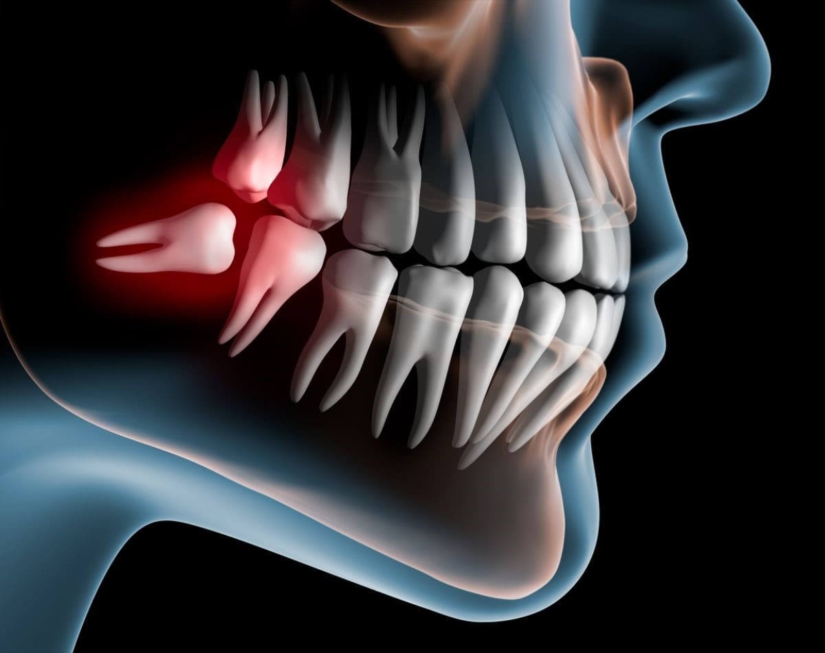 تشخیص درد دندان عقل