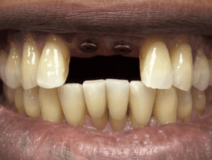 مراحل کلیدی در فرآیند جایگزینی دندان