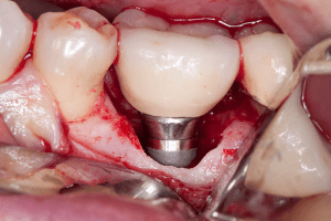 علائم و نشانه های تحلیل و پس زده شدن ایمپلنت دندان