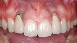 پس زدن ایمپلنت دندان چگونه تشخیص داده می شود؟