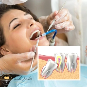 دندان عقل نهفته چیست؟