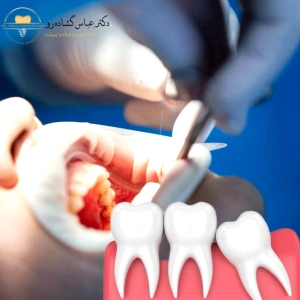 هدف از دندان عقل چیست؟