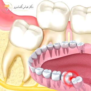 دندان عقل کاملاً نهفته، دندان عقل نیمه نهفته و دندان عقل غیر نهفته: تفاوت چیست؟