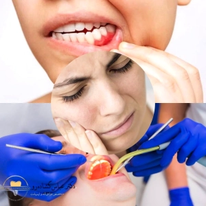 علائم دندان عقل نهفته کدامند؟