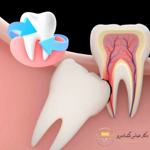 علت نهفته شدن دندان عقل چیست؟