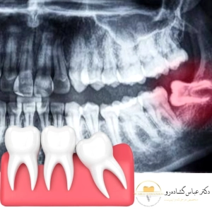 تشخیص نهفتگی دندان عقل چگونه انجام می شود؟