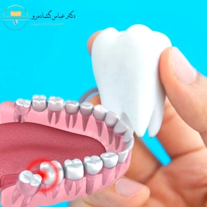 جراحی دندان عقل نهفته